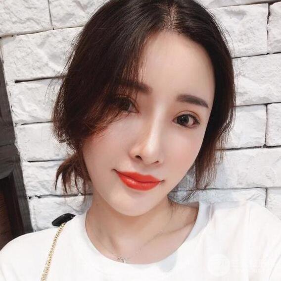 銀川崔大夫博士麗朱杰自體脂肪豐面頰恢復(fù)記錄附對(duì)比圖片