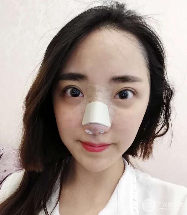 東莞寶格麗韋文奇隆鼻整形果圖分享，對比曝光