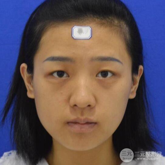 揚州美安雷岳崇切開雙眼皮+隆鼻整形恢復(fù)記錄