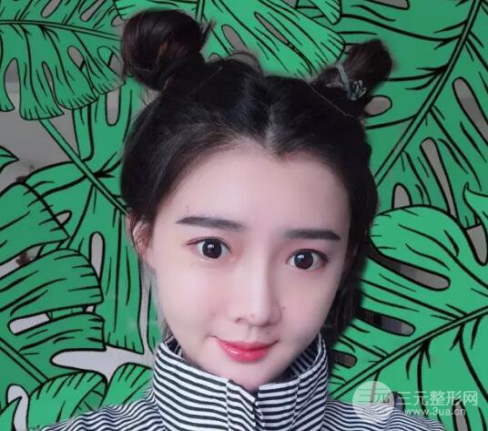 脂肪填充全臉恢復過程圖