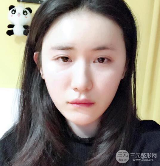 泉州億星醫(yī)療美容沈文鑫自體脂肪填充面部真人反饋