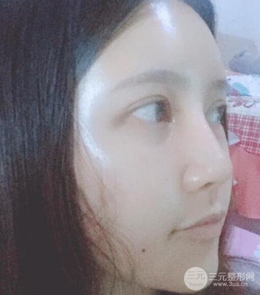 宜昌美岸醫(yī)療美容李英華自體脂肪面部填充怎么樣？真人日記曝光