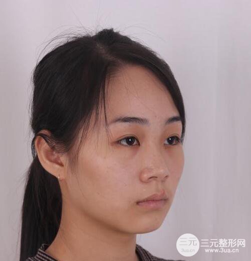 杭州恒顏醫(yī)療美容趙德星隆鼻整形手術(shù)恢復(fù)過程圖