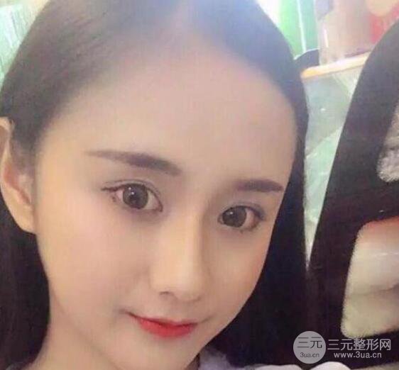 三亞三仁醫(yī)療美容于德印全切雙眼皮+開眼角一個月恢復(fù)圖來辣