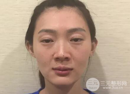 脂肪填充全臉恢復過程圖