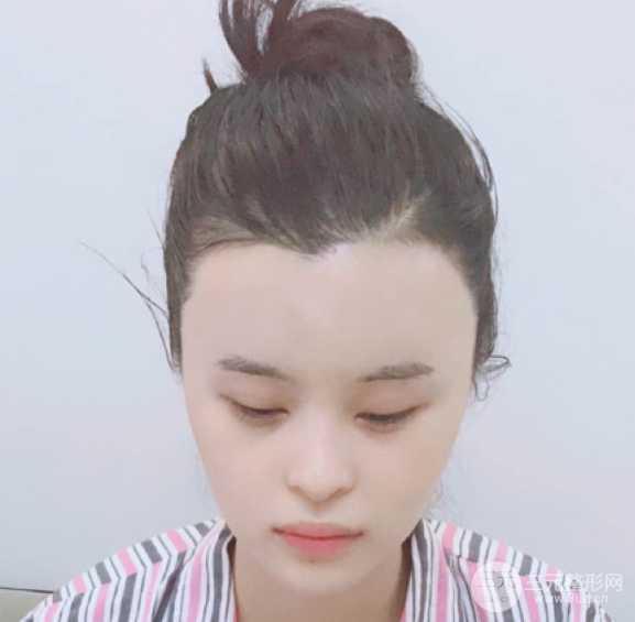 自體脂肪填充一個(gè)月真實(shí)恢復(fù)圖片，恢復(fù)后連閨蜜都驚艷辣