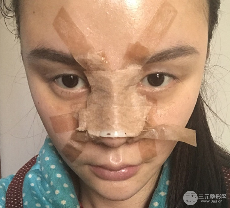 隆鼻整形三個(gè)月記錄，恢復(fù)后立體度不輸外國(guó)人
