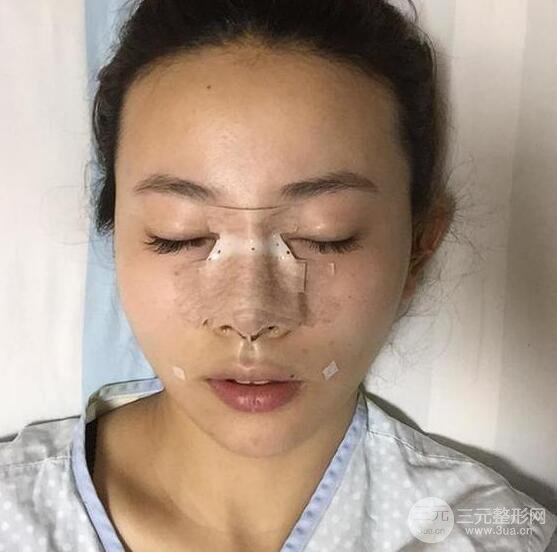 珠海陸達彭劍隆鼻整形術(shù)前術(shù)后對比