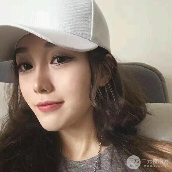 蘇州芘麗芙華美甘月圓自體脂肪填充全臉恢復(fù)記錄