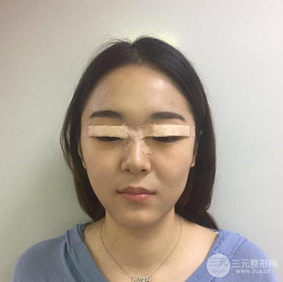 銀川西京整形醫(yī)院胡守舵【雙眼皮多項整形】全切雙眼皮真人案例