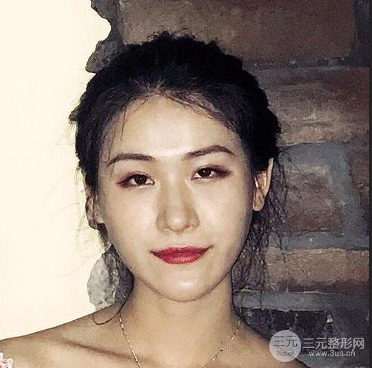 泉州億星醫(yī)療美容沈文鑫自體脂肪填充面部真人反饋