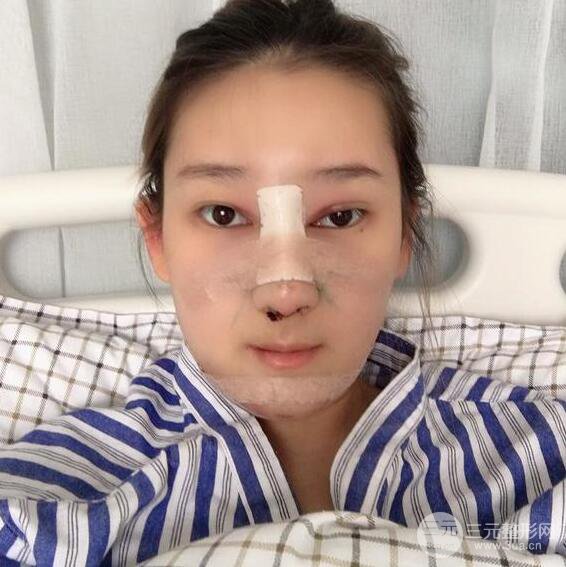 三亞三仁于德印肋軟骨隆鼻+硅膠墊下巴恢復(fù)對比圖