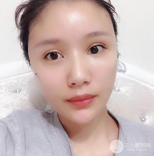 辣媽做了自體脂肪填充全臉，對比圖分享