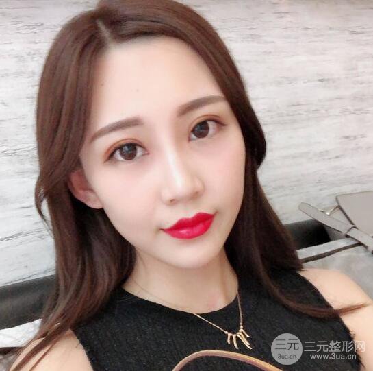 割雙眼皮兩個月是啥樣，妹子公開恢復(fù)記錄