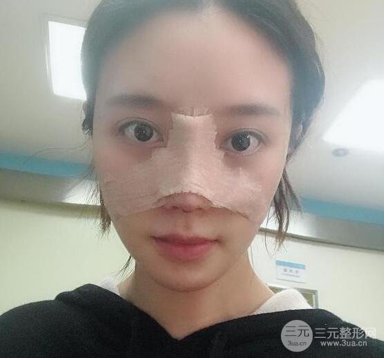 自體軟骨隆鼻恢復(fù)記錄，附對比圖片