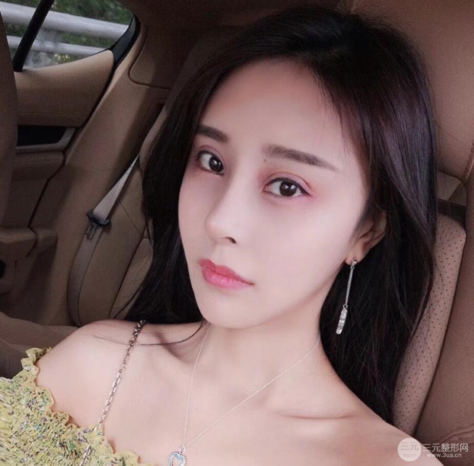 青島海倫整形朱洪濤肋軟骨隆鼻恢復(fù)記錄