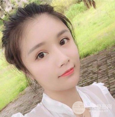 辣媽做了自體脂肪填充全臉，對比圖分享