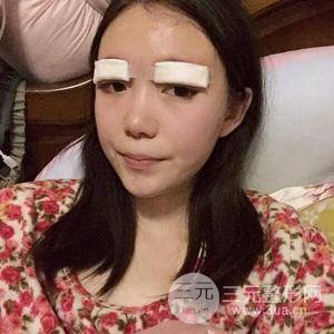 切開雙眼皮+上瞼下垂矯正術(shù)前術(shù)后果對(duì)比圖