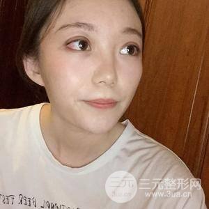 切開雙眼皮+上瞼下垂矯正術(shù)前術(shù)后果對(duì)比圖