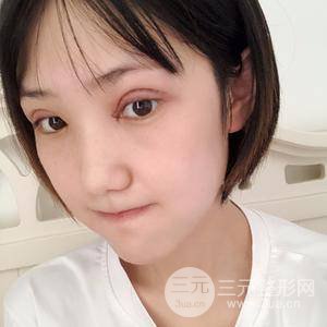 雙眼皮三個(gè)月果恢復(fù)圖