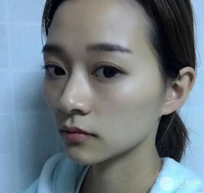 自體脂肪全臉填充三個(gè)月恢復(fù)圖，真實(shí)案例分享