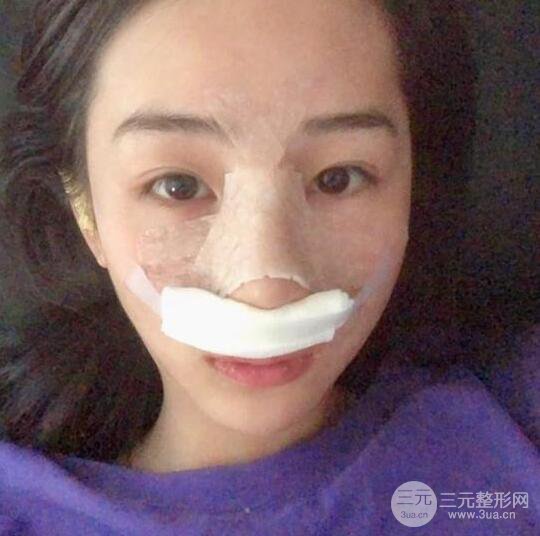 東莞寶格麗醫(yī)療美容韋文奇隆鼻整形60天恢復(fù)圖片
