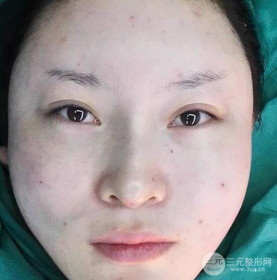 自體脂肪面部填充果怎么樣？對比反饋