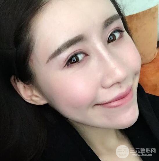 自體脂肪面部填充果對比圖