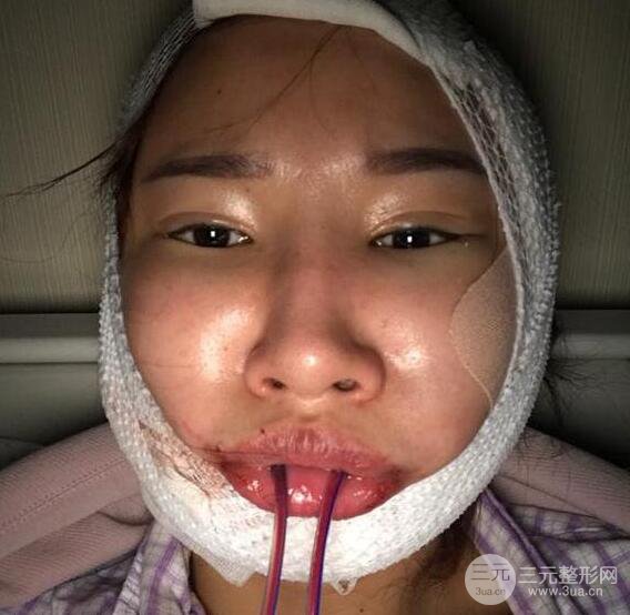 去下頜角+顴骨內(nèi)推手術(shù)三個月記錄，看大臉妹如何逆襲