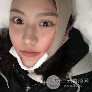 面部吸脂100天恢復(fù)果對(duì)比圖