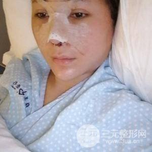 進口假體+肋軟骨墊鼻尖三個月果恢復對比圖