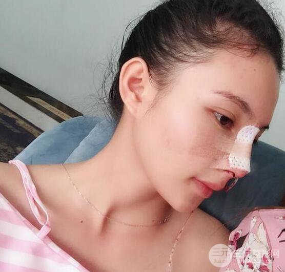 妹子做了隆鼻整形后竟變混血臉，來看看像baby還是娜扎