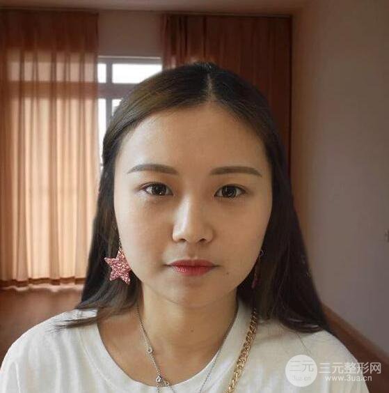 嘉和百旺醫(yī)療美容安波切開雙眼皮恢復(fù)記錄