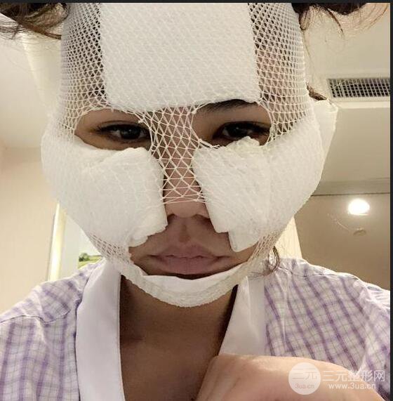 泉州億星閔英俊磨骨恢復(fù)圖分享