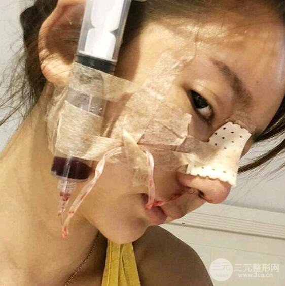 只是做了隆鼻整形改變居然辣么大，快來看看我的隆鼻整形恢復(fù)日記叭