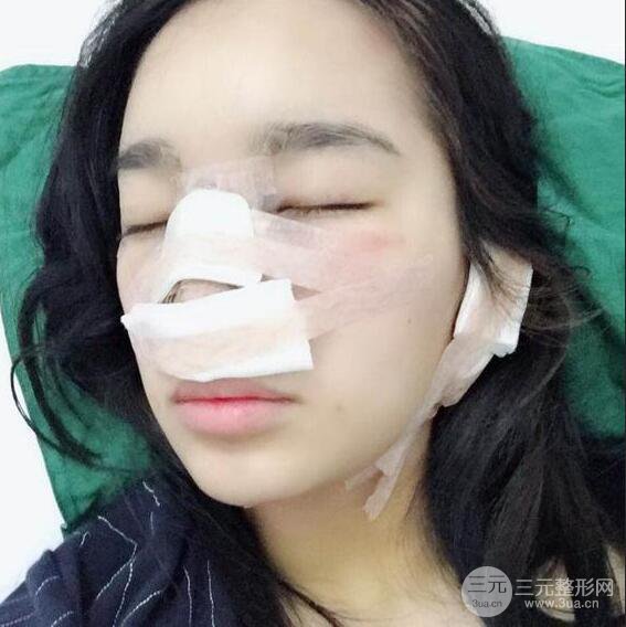 隆鼻整形術(shù)前術(shù)后對(duì)比照曝光，附經(jīng)驗(yàn)分享及心得體會(huì)