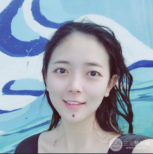 揚州艾菲斯黃嬋雙眼皮多項整形整形果真人反饋