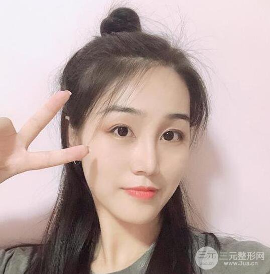 東莞寶格麗醫(yī)療美容韋文奇隆鼻整形60天恢復(fù)圖片