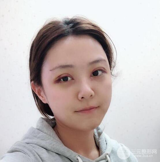 東莞君熠醫(yī)療美容李陵峰自體脂肪全臉填充恢復記錄