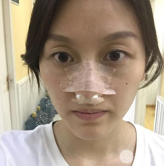 做了“埋埋蛋白線.提升+隆鼻整形”，恢復后老公說很沒有降低風險感