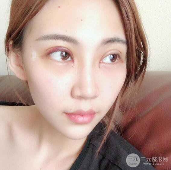 割雙眼皮兩個月是啥樣，妹子公開恢復(fù)記錄