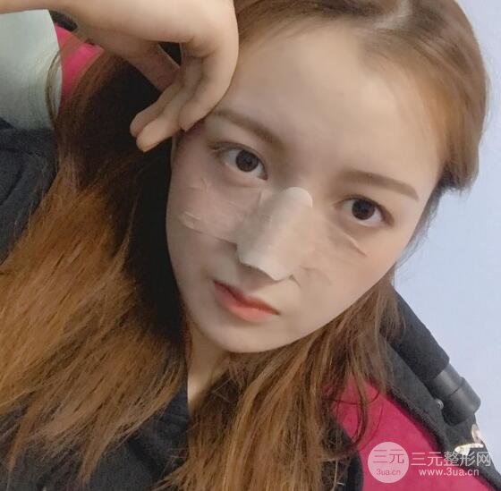 隆鼻整形多久恢復(fù)自然，模特公布隆鼻整形恢復(fù)記錄附照片
