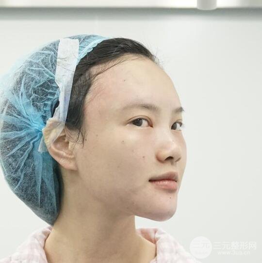 上海華美李健自體脂肪詳細部填充果圖，少女臉經(jīng)久不衰的秘密在這里