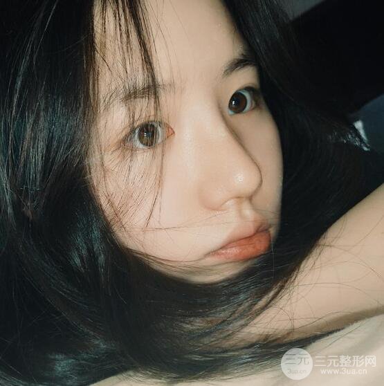 上海華美醫(yī)療美容李庭勛膨體隆鼻怎么樣？果對比圖