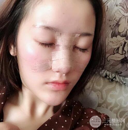 膨體隆鼻三十天恢復(fù)記錄，術(shù)前術(shù)后對比圖片曝光