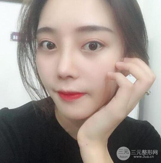 自體軟骨隆鼻恢復(fù)記錄，附對比圖片