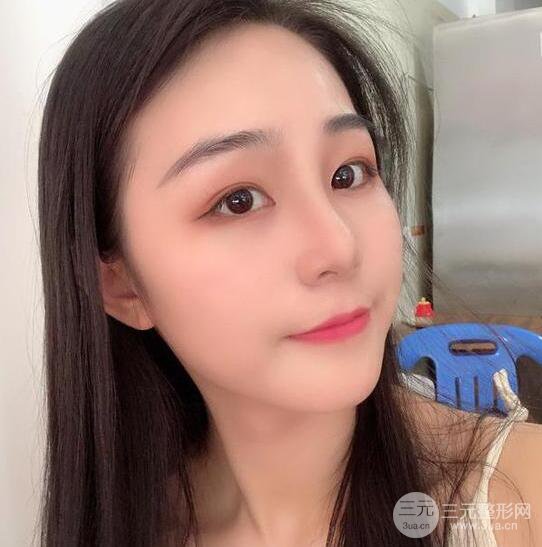 東莞寶格麗醫(yī)療美容韋文奇隆鼻整形60天恢復(fù)圖片