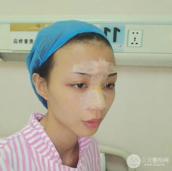 銀川崔大夫博士麗朱杰硅膠隆鼻恢復(fù)圖，輕松get精致臉