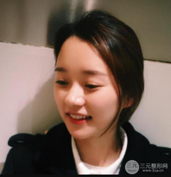 自體脂肪全臉填充三個(gè)月恢復(fù)圖，真實(shí)案例分享