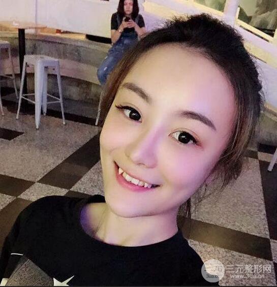 做了自體脂肪填充全臉，別人都以為我老公較為有錢